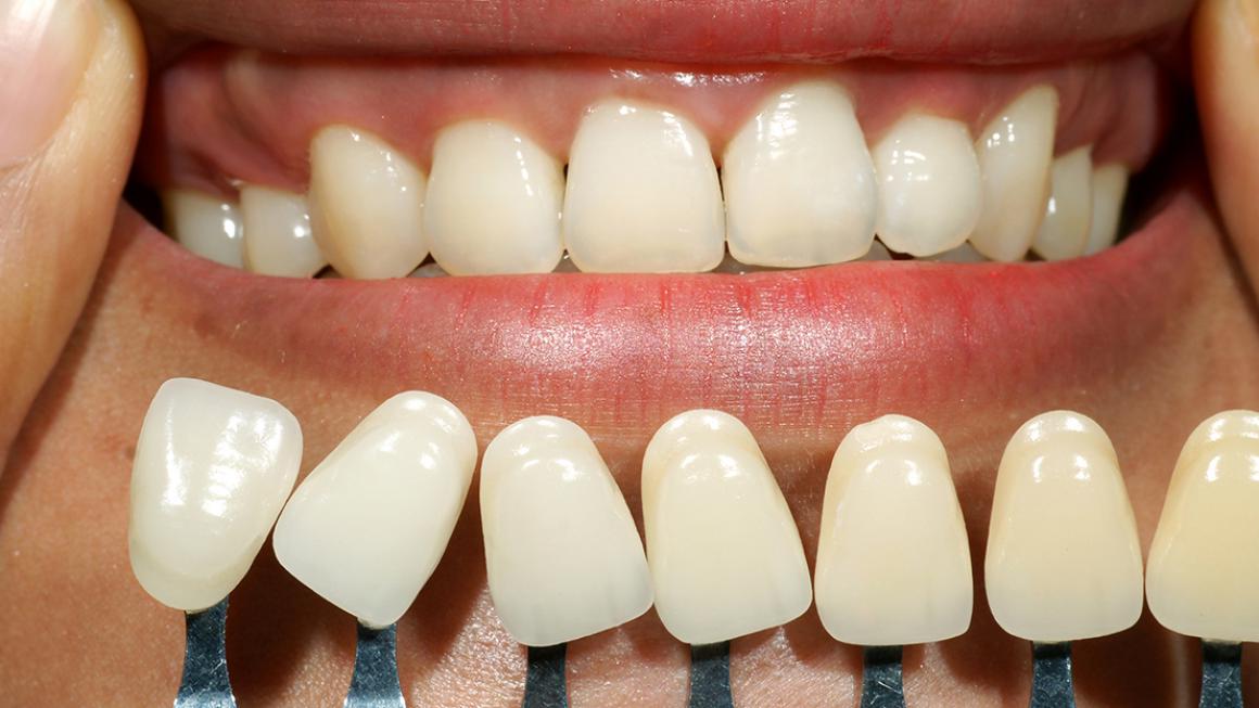 Diş Beyazlatma (Bleaching) Nedir?